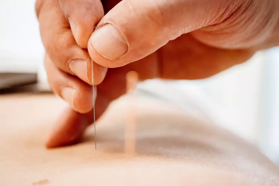 akupunktur Closeup einer Akupunkturnadel, die in den Rücken eines Patienten gestochen wird