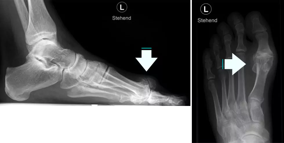 Hallux rigidus Röntgenbilder eines linken Fußes mit Hallux rigidus, Seitenansicht und Draufsicht