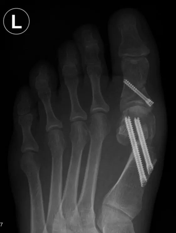 Hallux valgus Röntgenaufnahme Hallux valgus Röntgenaufnahme