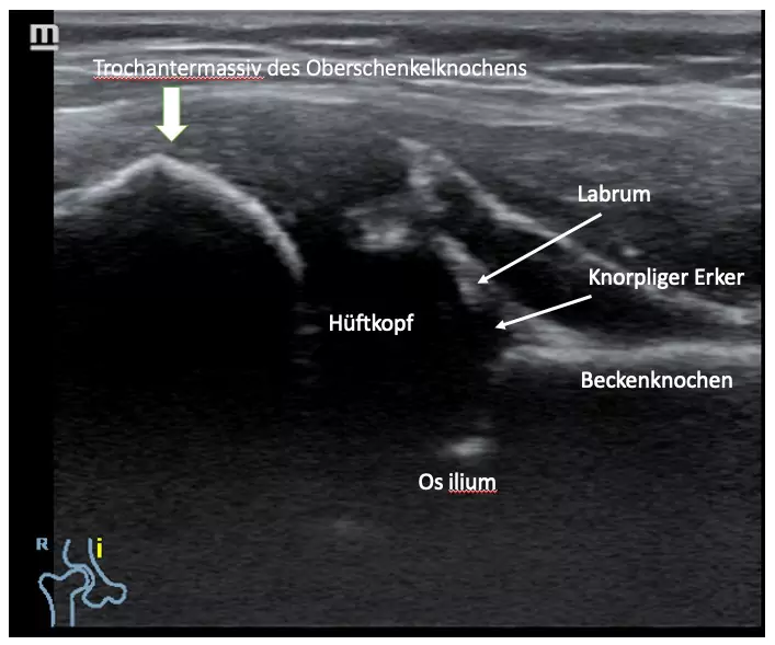 U3 HÜftsonographie U3 Hüft Ultraschalluntersuchung beim Säugling