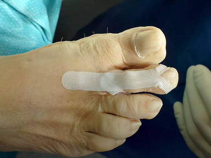 Verband am operierten Zeh Verband an einem Zeh nach der Operation zur Korrektur des Krallenzeh
