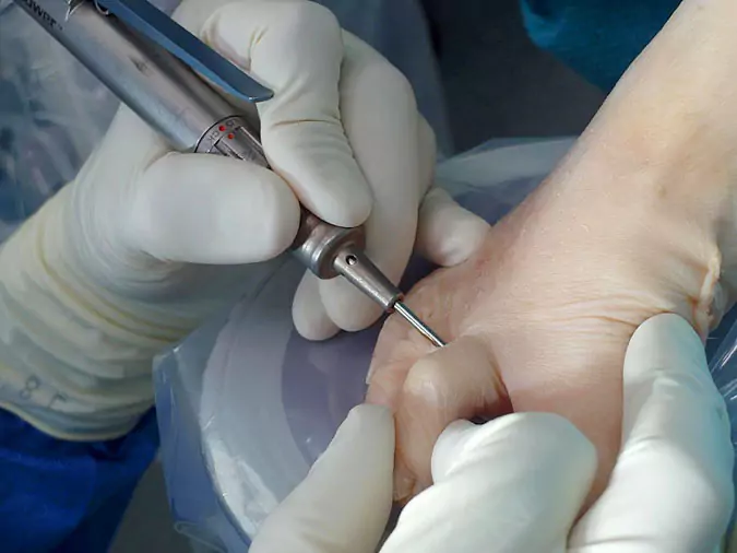 OP an einem Krallenzeh Closeup einer Operation an einem Krallenzeh