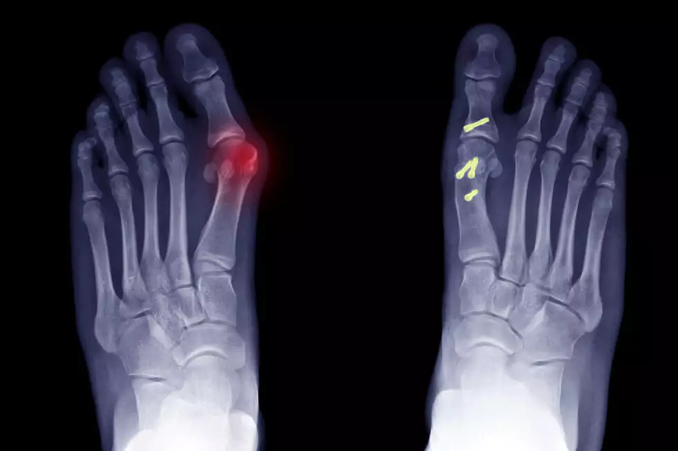 Röntgenbild Röntgenaufnahme eines Fußes zeigt eine Hallux-valgus-Deformität, die auf der rechten Seite durch einen chirurgischen Eingriff behandelt wird. Die linke Seite zeigt eine fortschreitende Erkrankung.