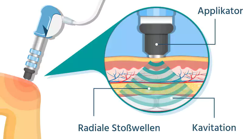 stosswellen illustration illustrierte Darstellung mit Detaildarstellung der Stoßwellentherapie am Knie und deren Wirkung am Muskel